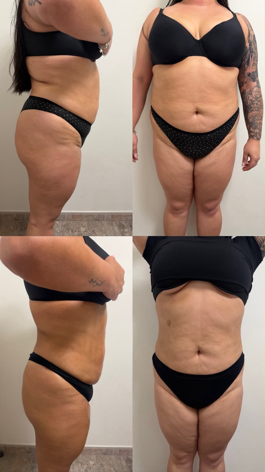 Antes e depois do primeiro protocolo corporal personalizado